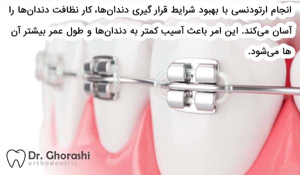 نحوه ارتودنسی فک بالا