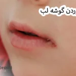 ترک خوردن گوشه لب