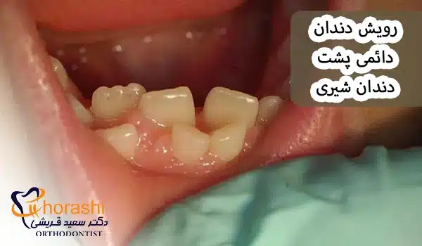 رویش دندان دائمی پشت دندان شیری