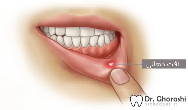 بررسی 17 راه برای درمان فوری آفت دهان در منزل