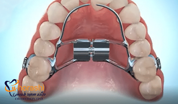 پالاتال اکسپندر (وسیع کننده کام) 