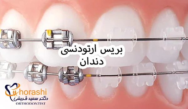 بریس ارتودنسی دندان