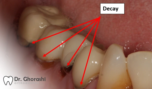 پوسیدگی دندان زیر روکش