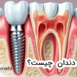 ایمپلنت دندان چیست؟