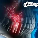 درد عصب دندان