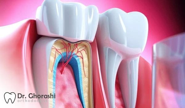 درمان ریشه دندان
