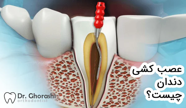 عصب کشی دندان چیست؟