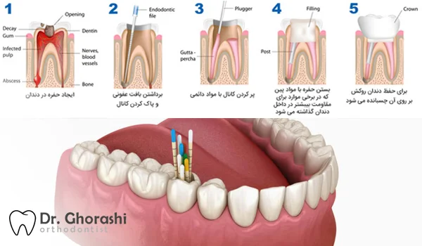 مراحل عصب کشی دندان