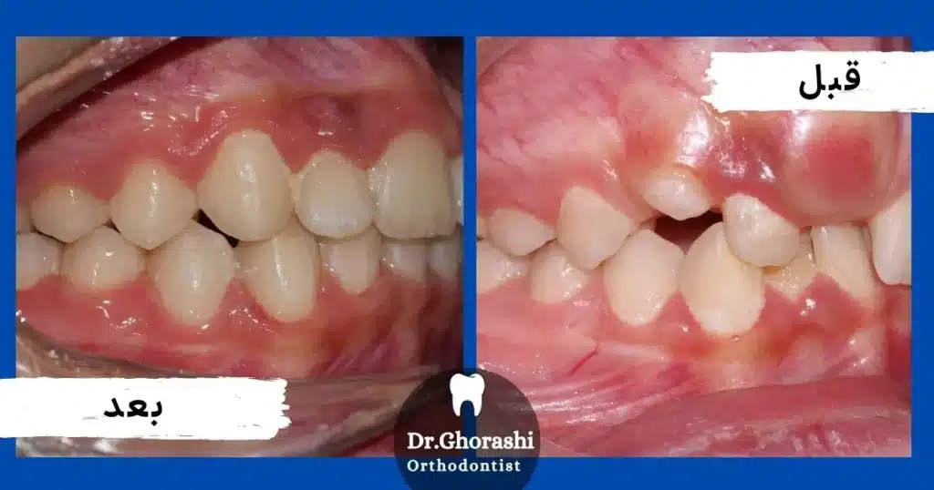 اصلاح نامرتبی و نهفتگی دندان ها در یک بیمار در ۲۴ ماه