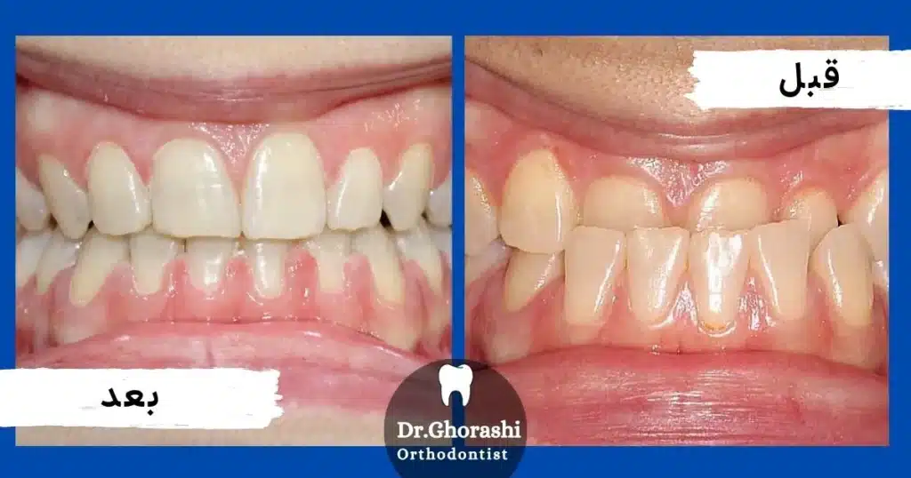 اصلاح رابطه کلاس III بدون جراحی در یک بیمار