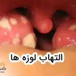 التهاب لوزه ها