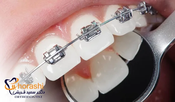 بریس ارتودنسی