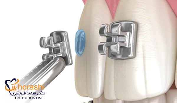 براکت ارتودنسی