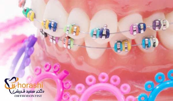 اورینگ های رنگی ارتودنسی