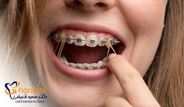 الاستیک در ارتودنسی