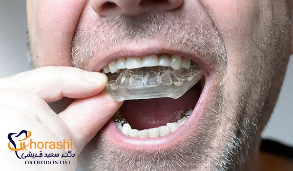 محافظ دهان یا نایت گارد ارتودنسی