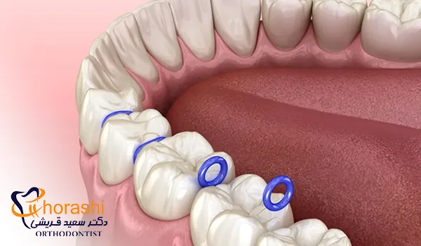 کاربرد سپریتور ارتودنسی