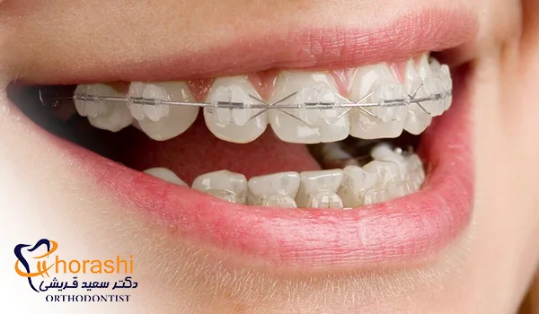 ارتودنسی با براکت سرامیکی
