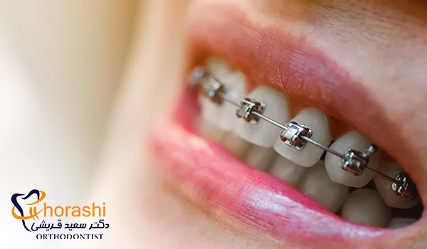 ارتودنسی دیمون