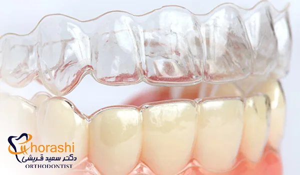 ارتودنسی نامرئی با الاینرهای شفاف
