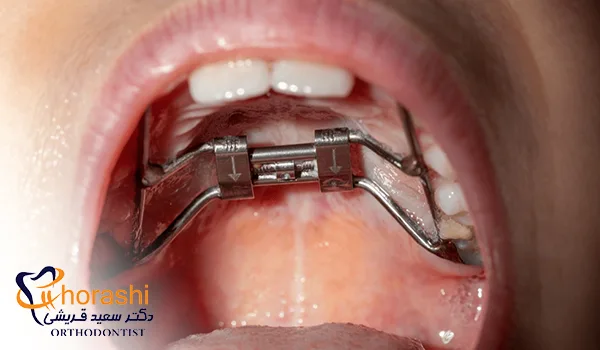 پالاتال اکسپندر یا وسیع کننده کام