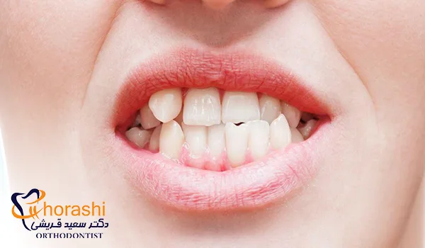 ناهنجاری فکی کراس‌ بایت