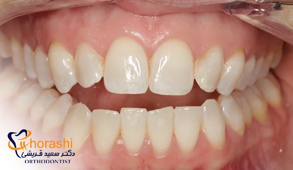 ناهنجاری فکی اپن بایت