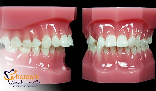 مال اکلوژن اورجت