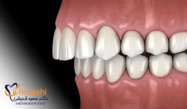 ناهمترازی فکی اوربایت