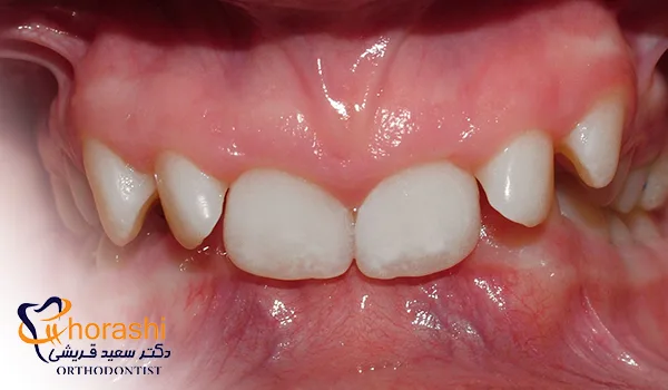 ناهنجاری دیپ بایت