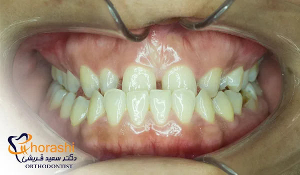 مال اکلوژن آندربایت