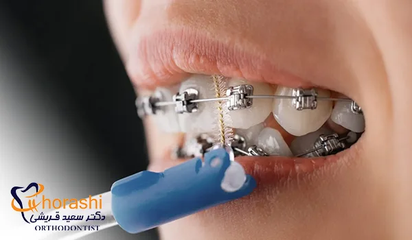 استفاده از مسواک بین دندانی در ارتودنسی