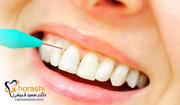 استفاده از مسواک بین دندانی برای دندان های ایمپلنت شده
