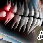 جراحی دندان عقل