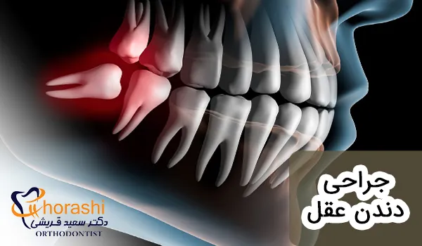جراحی دندان عقل