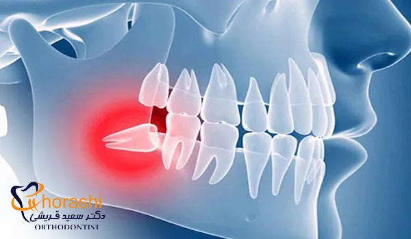 علائم هشداردهنده نیاز به جراحی کردن دندان عقل