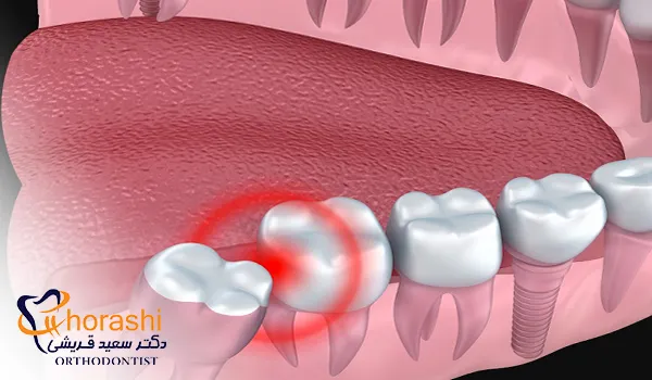 عکس جراحی دندان عقل نیمه نهفته فک پایین