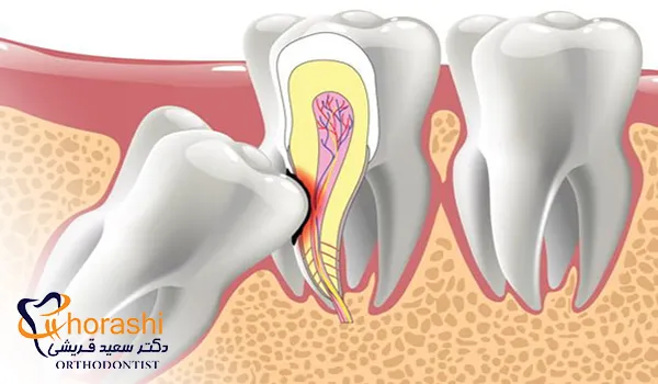 عکس جراحی دندان عقل روی عصب