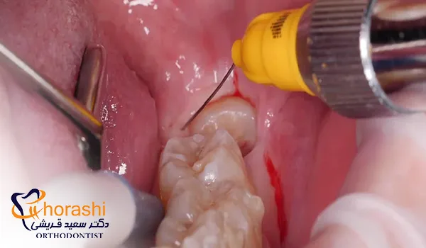 عکس مراحل جراحی دندان عقل