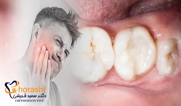 درد جراحی دندان عقل