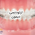ارتودنسی دیمون