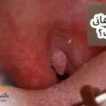 زگیل دهانی چیست؟