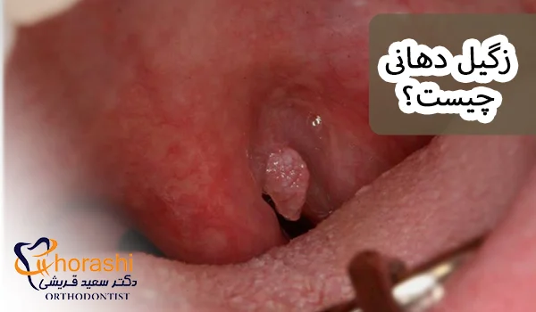 زگیل دهانی چیست؟