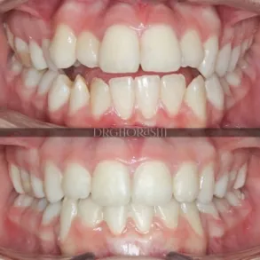 نمونه درمان ارتودنسی دکتر قریشی