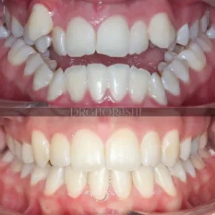 نمونه درمان ارتودنسی دکتر قریشی