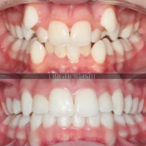 نمونه درمان ارتودنسی دکتر قریشی