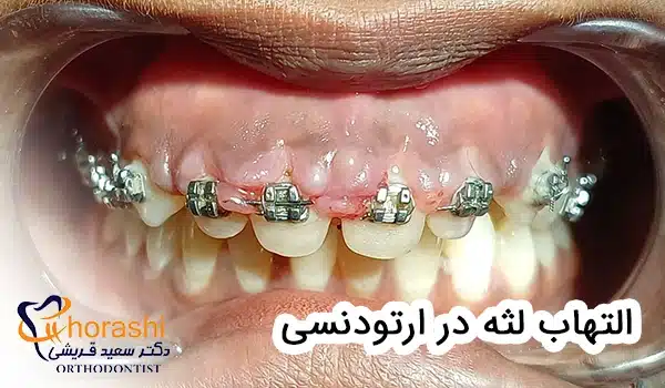 التهاب لثه در ارتودنسی