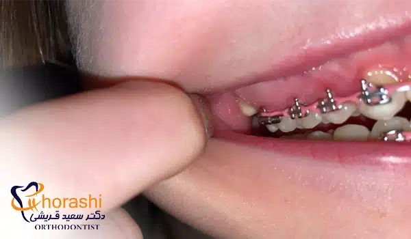 عکس التهاب لثه در ارتودنسی