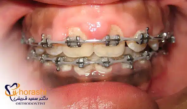 علائم عفونت  لثه در ارتودنسی