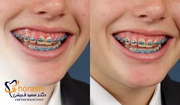 قبل و بعد درمان ورم لثه در ارتودنسی